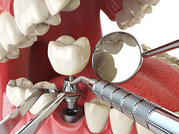 Best Emergency Treatment for Oral Infections in Iowa, LA